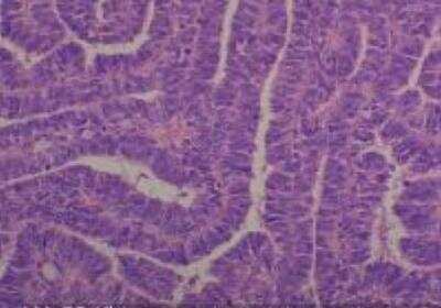 Hematoxylin & Eosin Stain: Human Common Tissue MicroArray (Cancer) [NBP2-30262] -  53. Kidney, nephrogenic carcinoma