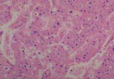 Hematoxylin & Eosin Stain: Human Common Tissue MicroArray (Cancer) [NBP2-30262] - 55.Kidney renal cell carcinoma, granular cell type