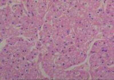 Hematoxylin & Eosin Stain: Human Common Tissue MicroArray (Cancer) [NBP2-30262] - 56.Kidney renal cell carcinoma