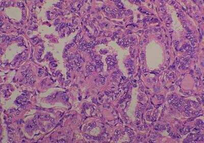 Hematoxylin & Eosin Stain: Human Common Tissue MicroArray (Cancer) [NBP2-30262] - 41. Thyroid papillary carcinoma T2N0M0, Stage I