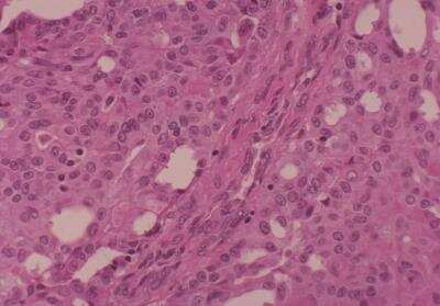 Hematoxylin & Eosin Stain: Human Common Tissue MicroArray (Cancer) [NBP2-30262] -  42. Thyroid papillary carcinoma T2N0M0, Stage I