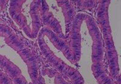 Hematoxylin & Eosin Stain: Human Common Tissue MicroArray (Cancer) [NBP2-30264] -  01. Endometrium Adenocarcinoma