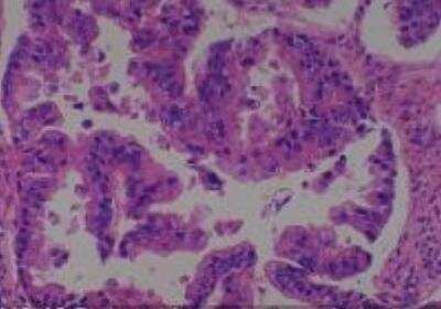 Hematoxylin & Eosin Stain: Human Common Tissue MicroArray (Cancer) [NBP2-30264] - 02. Endometrium Adenocarcinoma