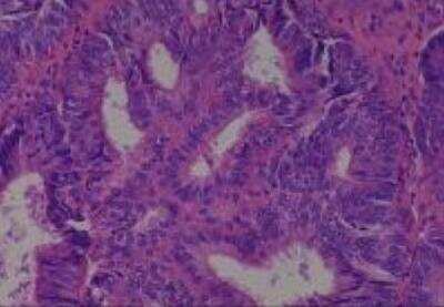 Hematoxylin & Eosin Stain: Human Common Tissue MicroArray (Cancer) [NBP2-30264] - 04. Endometrium adenocarcinoma