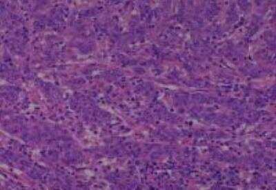 Hematoxylin & Eosin Stain: Human Common Tissue MicroArray (Cancer) [NBP2-30264] - 11. Gallbladder metastatic adenocarcinoma