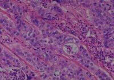 Hematoxylin & Eosin Stain: Human Common Tissue MicroArray (Cancer) [NBP2-30264] - 14. Gallbladder adenosquamous carcinoma