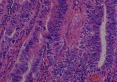 Hematoxylin & Eosin Stain: Human Common Tissue MicroArray (Cancer) [NBP2-30264] - 19. Gallbladder adenocarcinoma well differentiated