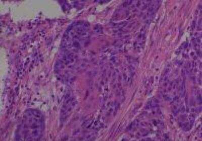 Hematoxylin & Eosin Stain: Human Common Tissue MicroArray (Cancer) [NBP2-30264] -  26. Larynx squamous cell carcinoma, moderately differentiated