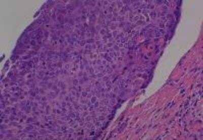 Hematoxylin & Eosin Stain: Human Common Tissue MicroArray (Cancer) [NBP2-30264] - 29. Oral cavity squamous cell carcinoma, well differentiated