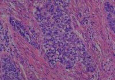 Hematoxylin & Eosin Stain: Human Common Tissue MicroArray (Cancer) [NBP2-30264] - 31. Uterine cervix squamous cell carcinoma