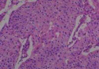 Hematoxylin & Eosin Stain: Human Common Tissue MicroArray (Cancer) [NBP2-30264] - 32. Uterine cervix squamous cell carcinoma