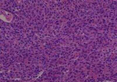 Hematoxylin & Eosin Stain: Human Common Tissue MicroArray (Cancer) [NBP2-30264] - 34. Uterine cervix squamous cell carcinoma