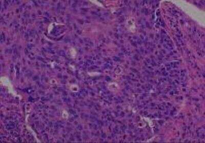 Hematoxylin & Eosin Stain: Human Common Tissue MicroArray (Cancer) [NBP2-30264] - 36. Uterine cervix squamous cell carcinoma