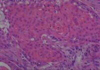 Hematoxylin & Eosin Stain: Human Common Tissue MicroArray (Cancer) [NBP2-30264] - 39. Uterine cervix squamous cell carcinoma