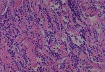 Hematoxylin & Eosin Stain: Human Common Tissue MicroArray (Cancer) [NBP2-30264] -  50. Duodenum malignant lymphoma, probably B cell origin