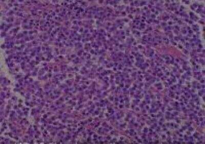 Hematoxylin & Eosin Stain: Human Common Tissue MicroArray (Cancer) [NBP2-30264] -  53.Skin, toe malignant melanoma