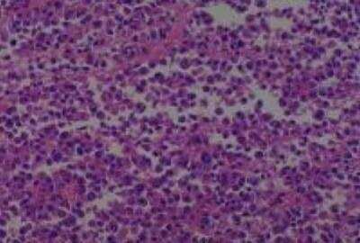 Hematoxylin & Eosin Stain: Human Common Tissue MicroArray (Cancer) [NBP2-30264] -  57.Skin, buttock malignant melanoma