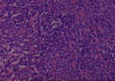 Hematoxylin & Eosin Stain: Human Common Tissue MicroArray (Cancer) [NBP2-30264] -  58.Skin, axilla malignant melanoma