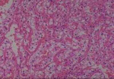 Hematoxylin & Eosin Stain: Human Kidney Tissue MicroArray (Cancer) [NBP2-30220] - 03. Kidney Cell carcinoma