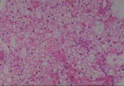 Hematoxylin & Eosin Stain: Human Kidney Tissue MicroArray (Cancer) [NBP2-30220] -  04. Kidney, renal cell carcinoma