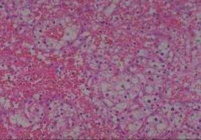 Hematoxylin & Eosin Stain: Human Kidney Tissue MicroArray (Cancer) [NBP2-30220] - 05. Kidney Renal cell carcinoma