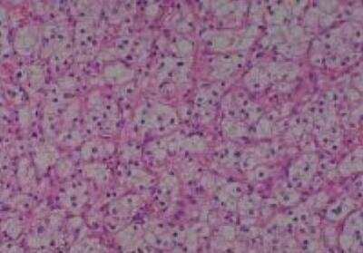 Hematoxylin & Eosin Stain: Human Kidney Tissue MicroArray (Cancer) [NBP2-30220] -  11. Kidney renal cell carcinoma