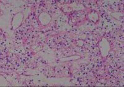 Hematoxylin & Eosin Stain: Human Kidney Tissue MicroArray (Cancer) [NBP2-30220] - 12. Kidney renal cell carcinoma