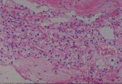 Hematoxylin & Eosin Stain: Human Kidney Tissue MicroArray (Cancer) [NBP2-30220] - 15. Kidney renal cell carcinoma