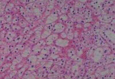 Hematoxylin & Eosin Stain: Human Kidney Tissue MicroArray (Cancer) [NBP2-30220] - 16. Kidney renal cell carcinoma