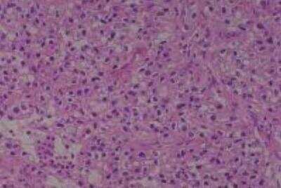 Hematoxylin & Eosin Stain: Human Kidney Tissue MicroArray (Cancer) [NBP2-30220] - 17. Kidney, Renal cell carcinoma