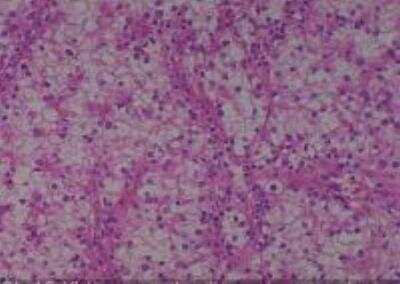 Hematoxylin & Eosin Stain: Human Kidney Tissue MicroArray (Cancer) [NBP2-30220] - 18. Kidney renal cell carcinoma, clear cell type