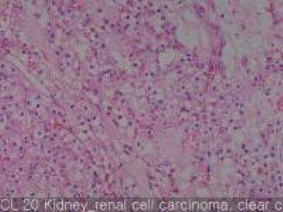 Hematoxylin & Eosin Stain: Human Kidney Tissue MicroArray (Cancer) [NBP2-30220] - 20. Kidney renal cell carcinoma, clear cell type