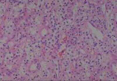 Hematoxylin & Eosin Stain: Human Kidney Tissue MicroArray (Cancer) [NBP2-30220] - 21. Kidney renal cell carcinoma, clear cell type