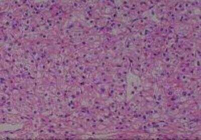 Hematoxylin & Eosin Stain: Human Kidney Tissue MicroArray (Cancer) [NBP2-30220] -  22. Kidney renal cell carcinoma, clear cell and granular cell type