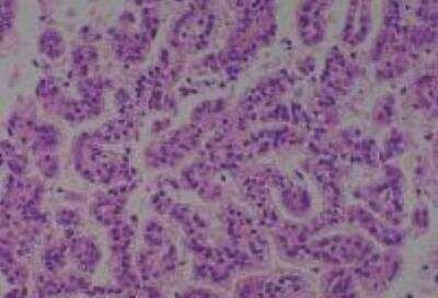 Hematoxylin & Eosin Stain: Human Kidney Tissue MicroArray (Cancer) [NBP2-30220] -  25. Kidney renal cell carcinoma, clear cell type