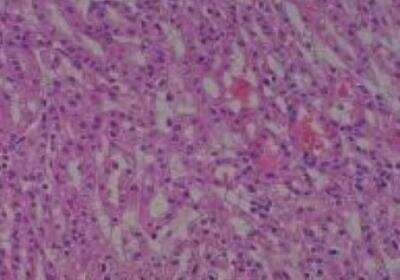 Hematoxylin & Eosin Stain: Human Kidney Tissue MicroArray (Cancer) [NBP2-30220] - 28. Kidney renal cell carcinoma