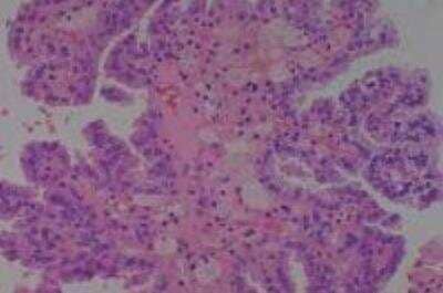 Hematoxylin & Eosin Stain: Human Kidney Tissue MicroArray (Cancer) [NBP2-30220] -  31. Kidney renal cell carcinoma, clear cell type