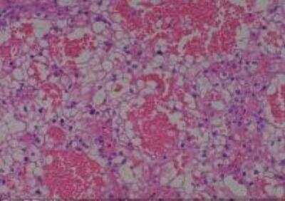 Hematoxylin & Eosin Stain: Human Kidney Tissue MicroArray (Cancer) [NBP2-30220] -  35. Kidney renal cell carcinoma, clear cell type