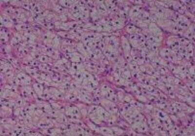 Hematoxylin & Eosin Stain: Human Kidney Tissue MicroArray (Cancer) [NBP2-30220] -  38. Kidney renal cell carcinoma, clear cell type