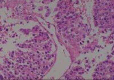 Hematoxylin & Eosin Stain: Human Kidney Tissue MicroArray (Cancer) [NBP2-30220] -  41. Kidney transitional cell carcinoma, pelvis