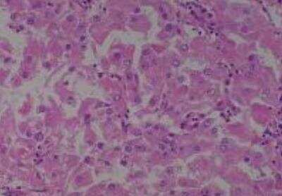 Hematoxylin & Eosin Stain: Human Kidney Tissue MicroArray (Cancer) [NBP2-30220] -  44. Kidney, Renal cell carcinoma granula