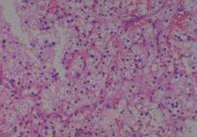 Hematoxylin & Eosin Stain: Human Kidney Tissue MicroArray (Cancer) [NBP2-30220] -  45.  Kidney renal cell carcinoma, clear cell type