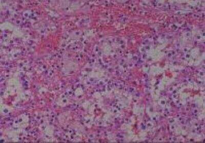 Hematoxylin & Eosin Stain: Human Kidney Tissue MicroArray (Cancer) [NBP2-30220] -  49. Kindey renal cell carcinoma