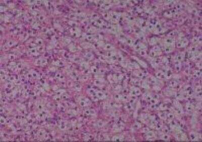 Hematoxylin & Eosin Stain: Human Kidney Tissue MicroArray (Cancer) [NBP2-30220] -  50. Kidney renal cell carcinoma clear cell type