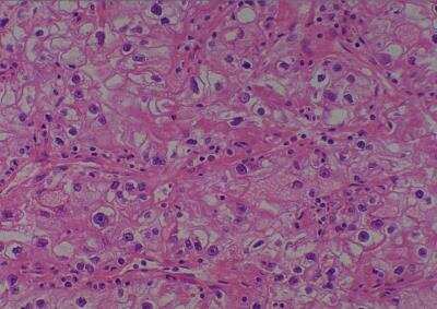 Hematoxylin & Eosin Stain: Human Kidney Tissue MicroArray (Cancer) [NBP2-30220] - 26. Kidney renal cell carcinoma, clear cell type T3aN0M0