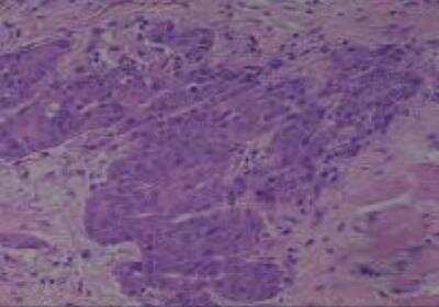 Hematoxylin & Eosin Stain: Human Larynx and Pharynx Tissue MicroArray (Cancer) [NBP2-30270] - 01. Larynx, Pyriform Sinus squamous Cell