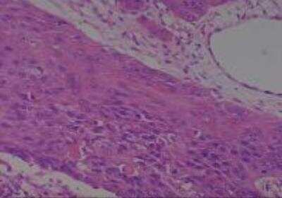 Hematoxylin & Eosin Stain: Human Larynx and Pharynx Tissue MicroArray (Cancer) [NBP2-30270] -  2. Larynx subglottic squamous cell carcinoma