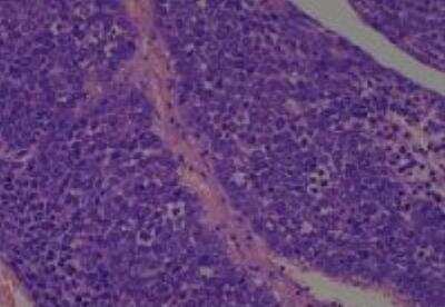 Hematoxylin & Eosin Stain: Human Larynx and Pharynx Tissue MicroArray (Cancer) [NBP2-30270] - 04. Esophagus squamous carcinoma