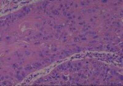 Hematoxylin & Eosin Stain: Human Larynx and Pharynx Tissue MicroArray (Cancer) [NBP2-30270] - 05. Larynx, transglottic squamous cell carcinoma