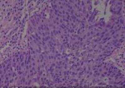 Hematoxylin & Eosin Stain: Human Larynx and Pharynx Tissue MicroArray (Cancer) [NBP2-30270] - 06. Larynx pyriform, sinus squamous cell carcinoma